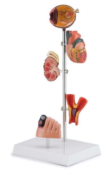 Effects Of Diabetes 5 Parts product photo